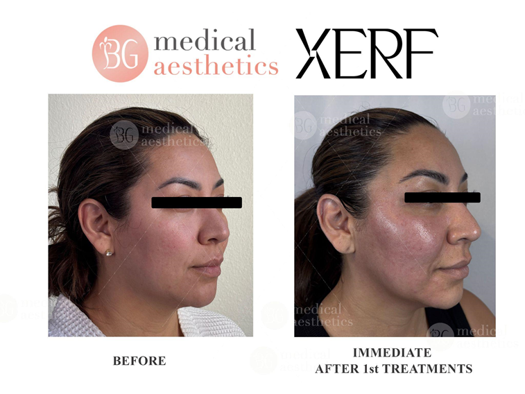 Marionette lines / Sagging jawline / Loss of elasticity