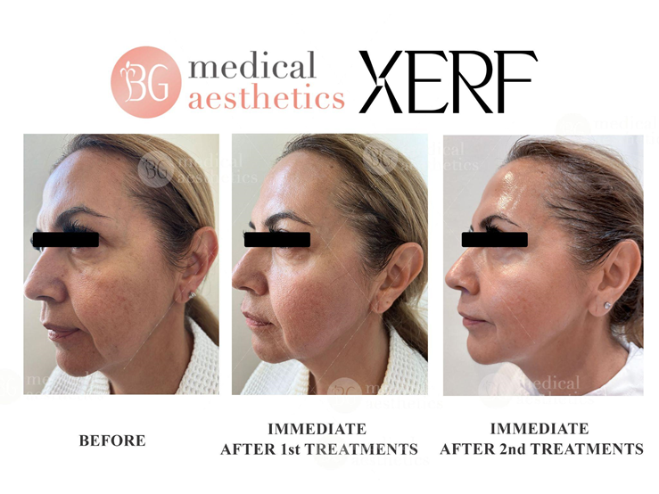 Marionette lines / Sagging jawline / Loss of elasticity