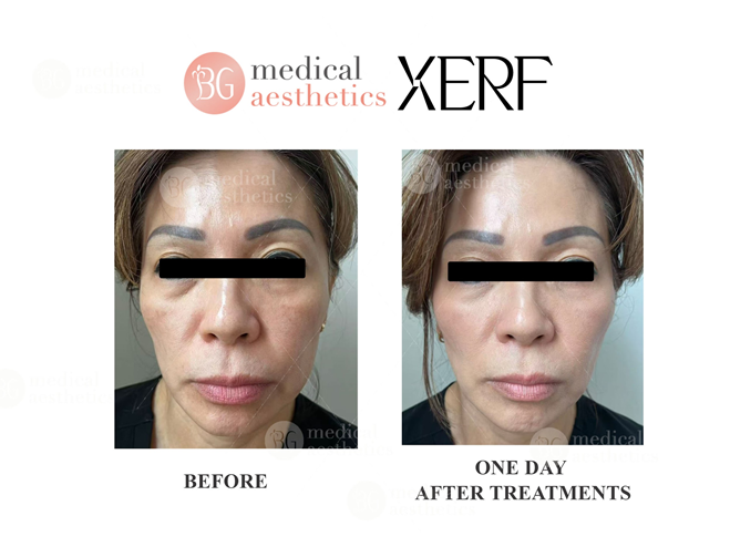 Wrinkles & Skin Laxity