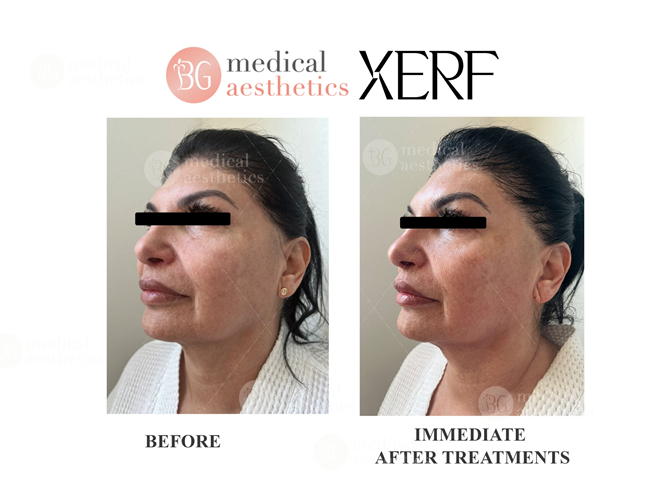 Wrinkles & Skin Laxity